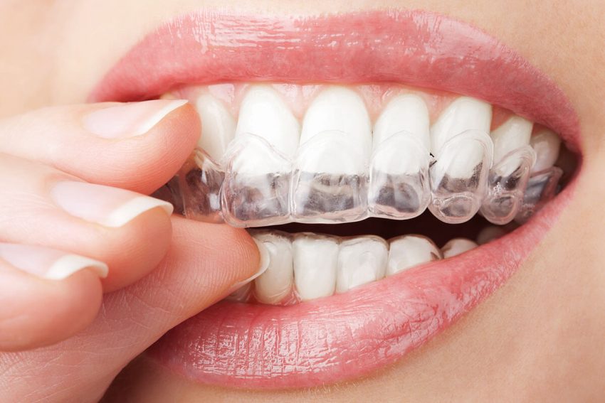 Unlocking Confidence: The Art of Invisalign Craftsmanship